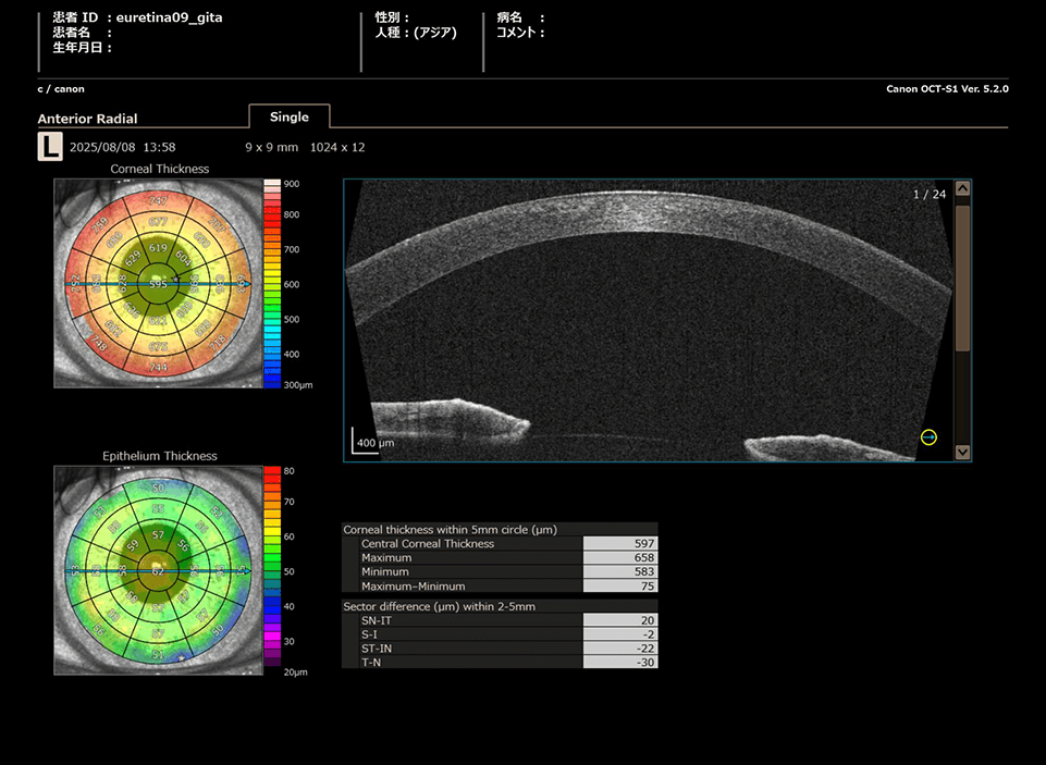 Anterior Radial：角膜厚・上皮厚の厚みマップレポート