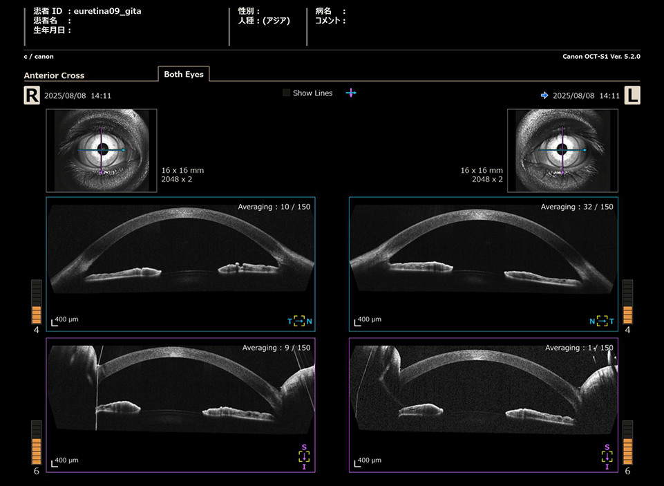 Anterior Cross：前眼部OCT 両隅角画像レポート